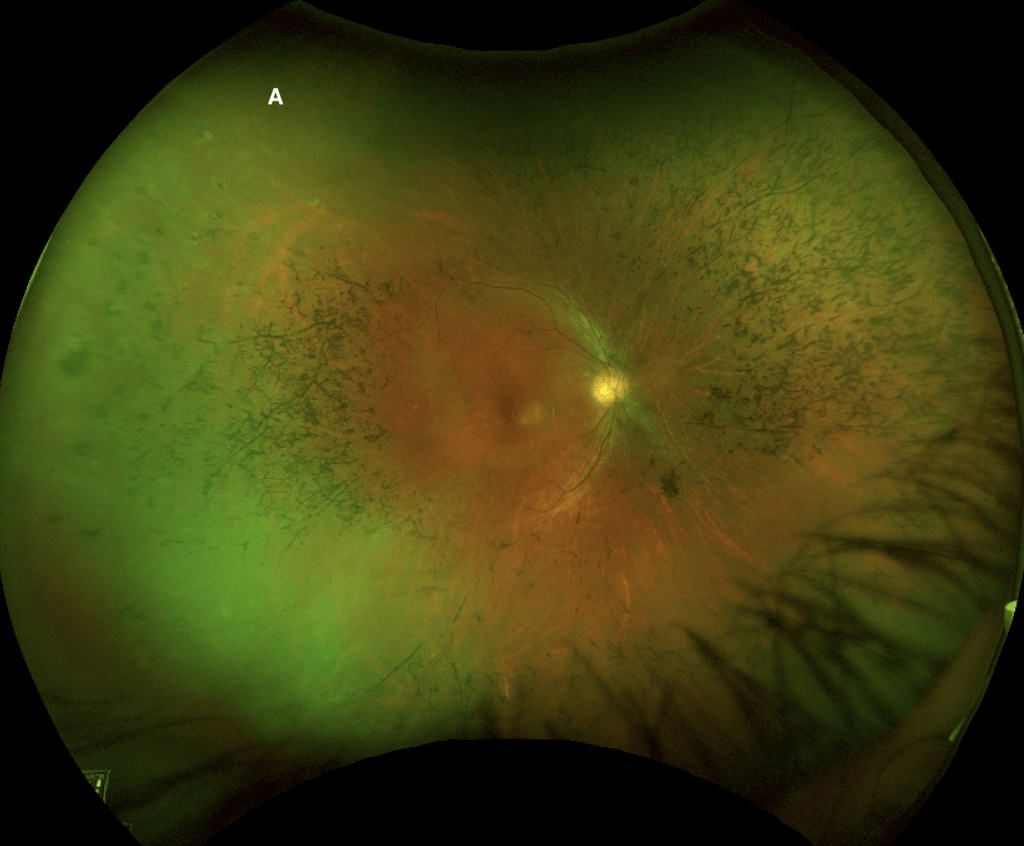 Figure 1a: Wide-field fundus photograph of the right (A) eye. Note the significant bone spicules, vascular attenuated, and optic disc pallor in both eyes.