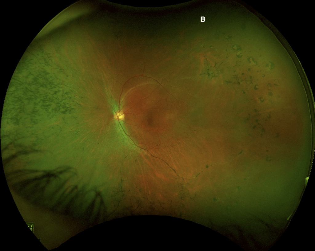 Figure 1b: Wide-field fundus photograph of the left eye (B). Note the significant bone spicules, vascular attenuated, and optic disc pallor in both eyes.